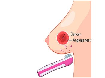 عکس کاربرد دستگاه معاینه سینه برست لایت انگلستان - Breastlight Usage depiction