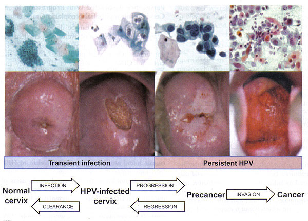 مراحل گسترش سرطان دهانه رحم - کولپوسکوپی زگیل تناسلی